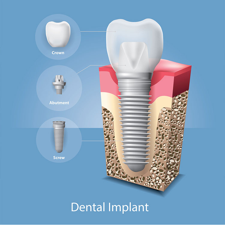 Best Dental Implants